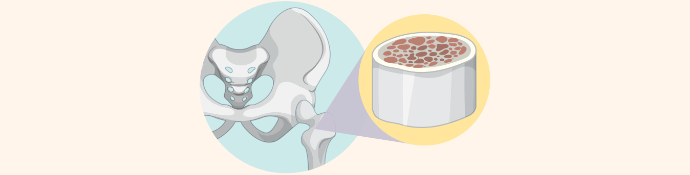 Understanding different types of bone marrow transplant